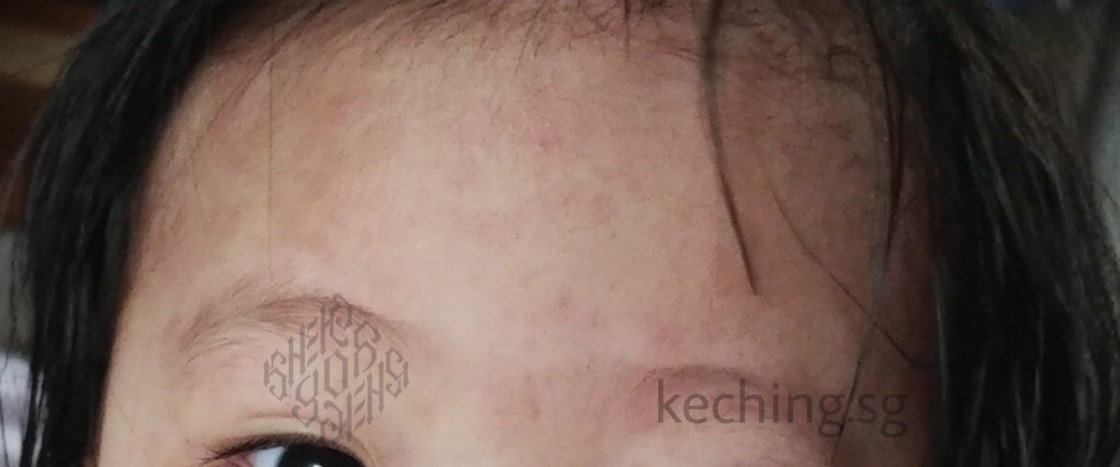 what does dengue rash look like